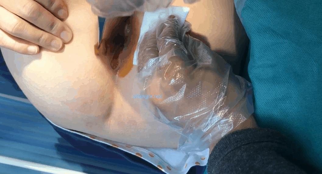 图片[4]-医院内部教学视频流出给女痔疮患者换药过程-uu欢迎您！
